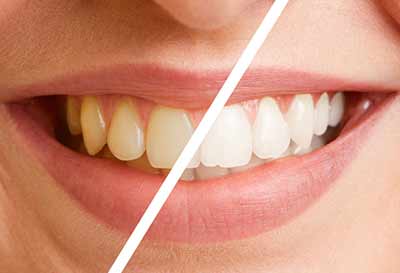 Zähne vor der Prophylaxe und nach der Prophylaxe